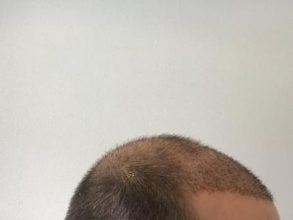 emrah-cinik-hair-transplant-center (27)