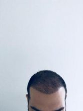 emrah-cinik-hair-transplant-center (29)