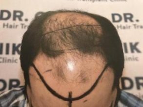 emrah-cinik-hair-transplant-center (8)