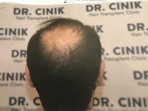 emrah-cinik-hair-transplant-center (9)
