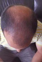 zekeriya-kul-hair-transplant-result (10)