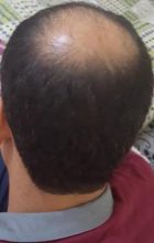 zekeriya-kul-hair-transplant-result (11)
