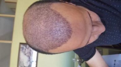zekeriya-kul-hair-transplant-result (14)