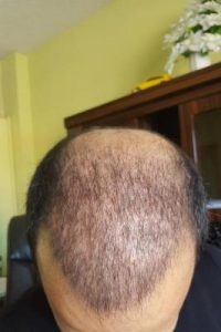 zekeriya-kul-hair-transplant-result (15)
