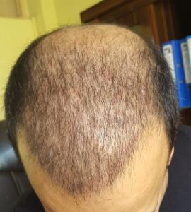 zekeriya-kul-hair-transplant-result (16)