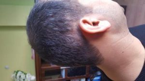 zekeriya-kul-hair-transplant-result (17)