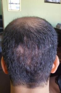 zekeriya-kul-hair-transplant-result (19)