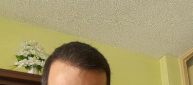 zekeriya-kul-hair-transplant-result (2)