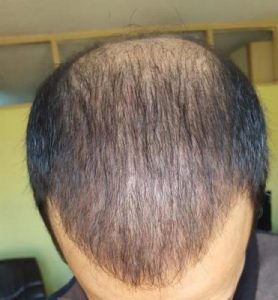 zekeriya-kul-hair-transplant-result (20)