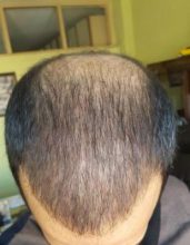 zekeriya-kul-hair-transplant-result (21)