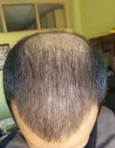 zekeriya-kul-hair-transplant-result (21)