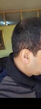 zekeriya-kul-hair-transplant-result (22)