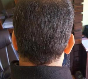 zekeriya-kul-hair-transplant-result (24)