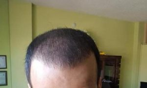 zekeriya-kul-hair-transplant-result (25)