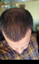 zekeriya-kul-hair-transplant-result (26)