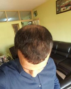 zekeriya-kul-hair-transplant-result (27)