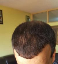 zekeriya-kul-hair-transplant-result (28)