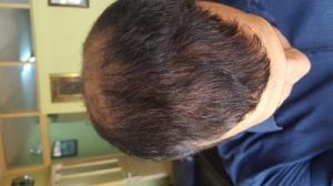 zekeriya-kul-hair-transplant-result (29)