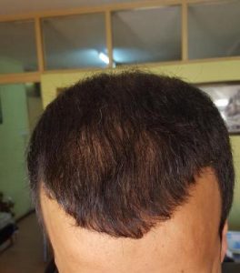 zekeriya-kul-hair-transplant-result (30)