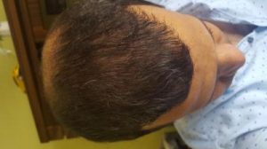 zekeriya-kul-hair-transplant-result (31)