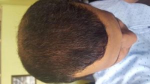 zekeriya-kul-hair-transplant-result (32)