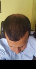 zekeriya-kul-hair-transplant-result (33)