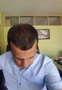 zekeriya-kul-hair-transplant-result (34)