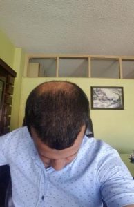 zekeriya-kul-hair-transplant-result (35)