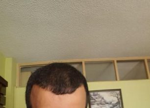 zekeriya-kul-hair-transplant-result (36)