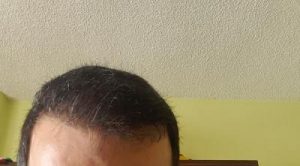 zekeriya-kul-hair-transplant-result (37)