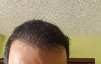 zekeriya-kul-hair-transplant-result (38)