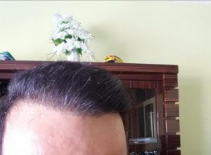 zekeriya-kul-hair-transplant-result (4)