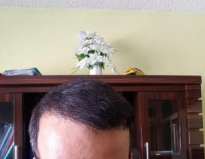 zekeriya-kul-hair-transplant-result (6)