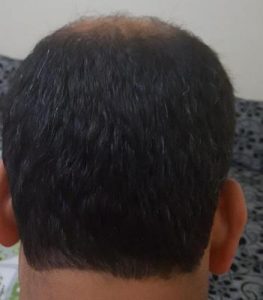 zekeriya-kul-hair-transplant-result (8)