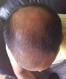 zekeriya-kul-hair-transplant-result (9)