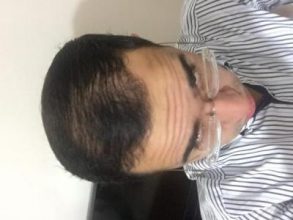 3650-grafts-hair-transplant (1)