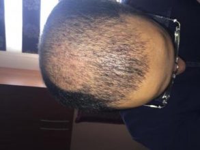 3650-grafts-hair-transplant (11)