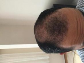3650-grafts-hair-transplant (12)