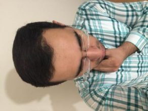 3650-grafts-hair-transplant (13)