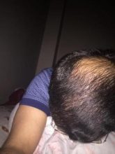 3650-grafts-hair-transplant (15)