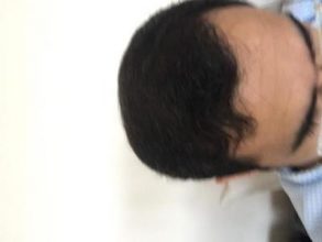 3650-grafts-hair-transplant (16)