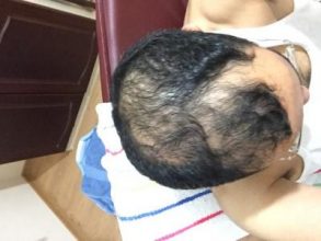 3650-grafts-hair-transplant (2)