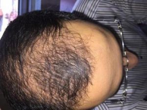 3650-grafts-hair-transplant (20)
