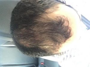 3650-grafts-hair-transplant (21)