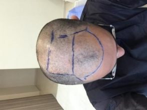 3650-grafts-hair-transplant (3)