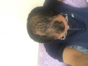 3650-grafts-hair-transplant (4)