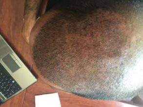 3650-grafts-hair-transplant (5)