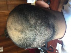 3650-grafts-hair-transplant (6)
