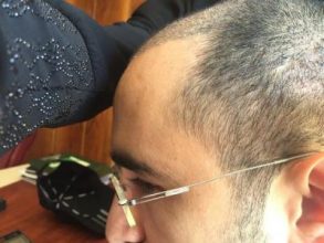 3650-grafts-hair-transplant (7)