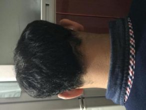 3650-grafts-hair-transplant (8)